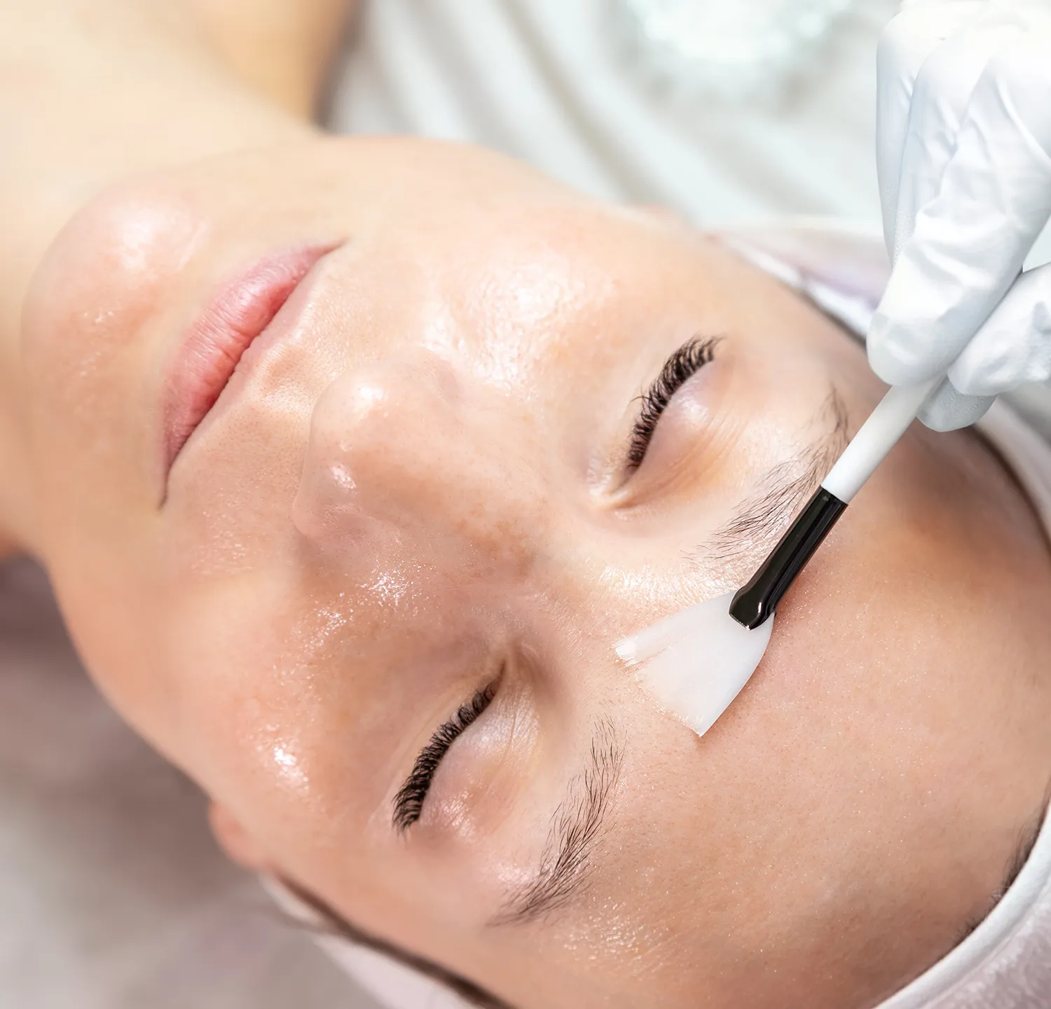 Chemical Peels in Brooklyn, NY